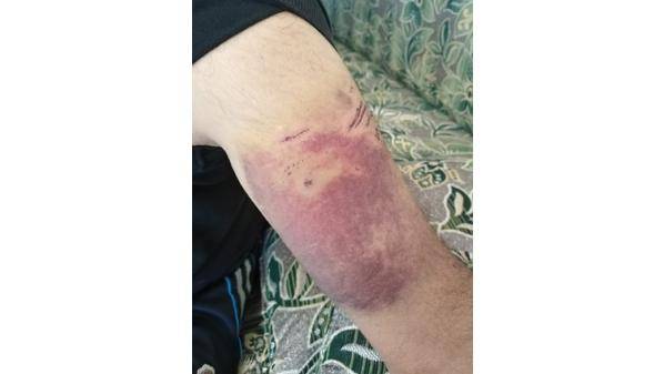 عجلون : كلب ضال يهاجم خمسينيا في بلدة سامتا وضح النهار اثناء حماية طلاب المدرسة