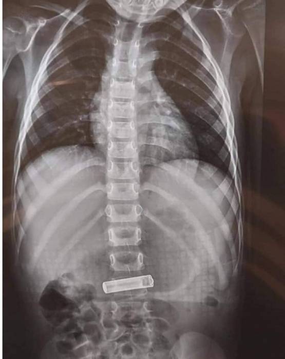 فريق طبي يستخرج بطارية ريموت من معدة طفل بعمّان  ...صور 