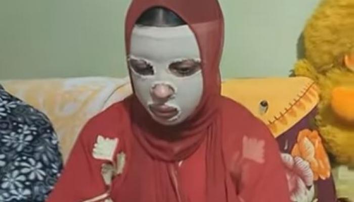 رفضت الزواج منه.. مصري يشوّه وجه حبيبته بماء النار