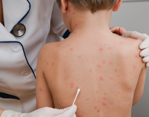 الصحة العالمية تعلن جدري القردة حالة طوارئ دولية