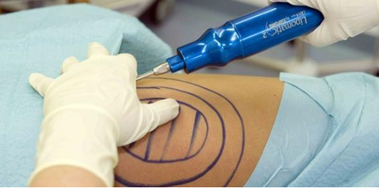 الأردن.. مريضة الشفط أجرت العملية داخل صالون