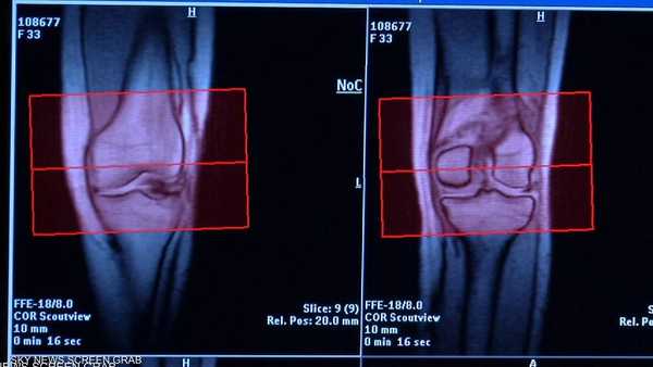 دراسة تحذر من حقنة المفاصل.. أخطر مما تتصور
