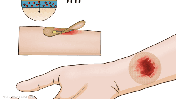 إنجاز طبي كبير.. ضمادة ذكية لها مفعول السحر مع الجروح