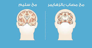 علاج جديد للزهايمر يثبت فعاليته