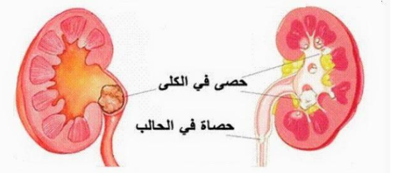 تخلص من حصوات المرارة بوصفات طبيعية وبسيطة