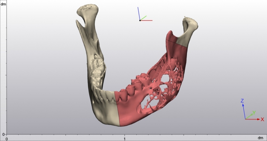 باستخدام الطباعة ثلاثية الأبعاد .. استئصال ورم سريع الانتشار من فك مريضة بالسعودية