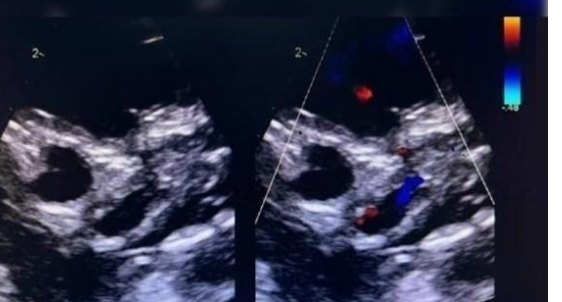 عملية تنقذ رضيعة مولودة بحالة قلب نادرة في السعودية