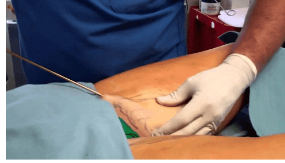 شفط الدهون أكثر الجراحات شيوعا بالعالم