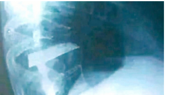 لازمه 25 عامًا.. أطباء يخرجون خنجر من ظهر جزائري وهذه حالته