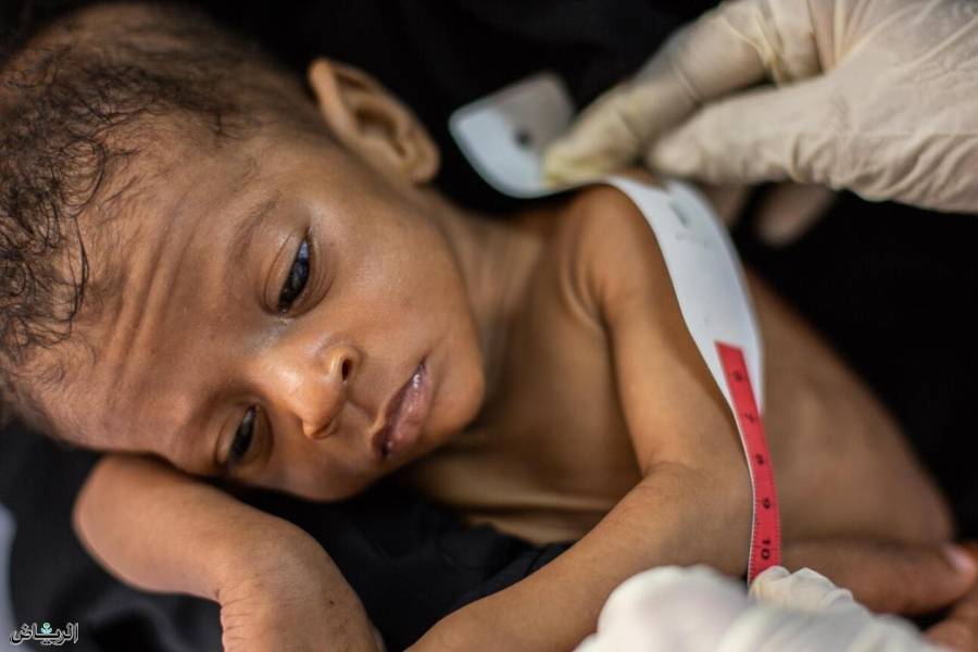 الأمم المتحدة تطلق نداءً لإنقاذ 30 مليون طفل يعانون سوء تغذية حاداً