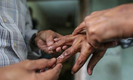 في يومه العالمي.. الجذام يسبب معاناة نفسية للمصابين به