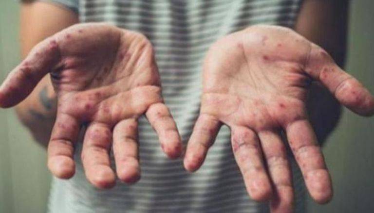 منظمة الصحة العالمية تعلن إحصائية بـقتلى جدري القرود