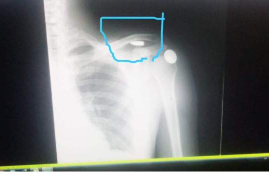 الأردن.. تفاصيل اختراق رصاصة طائشة كتف وافد