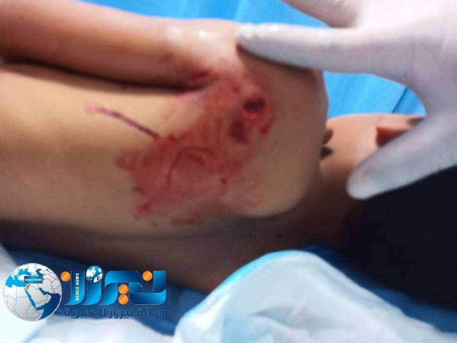 كلب ضال يلتهم كتف طفل في ام بطمه بلواء الموقر ..صور