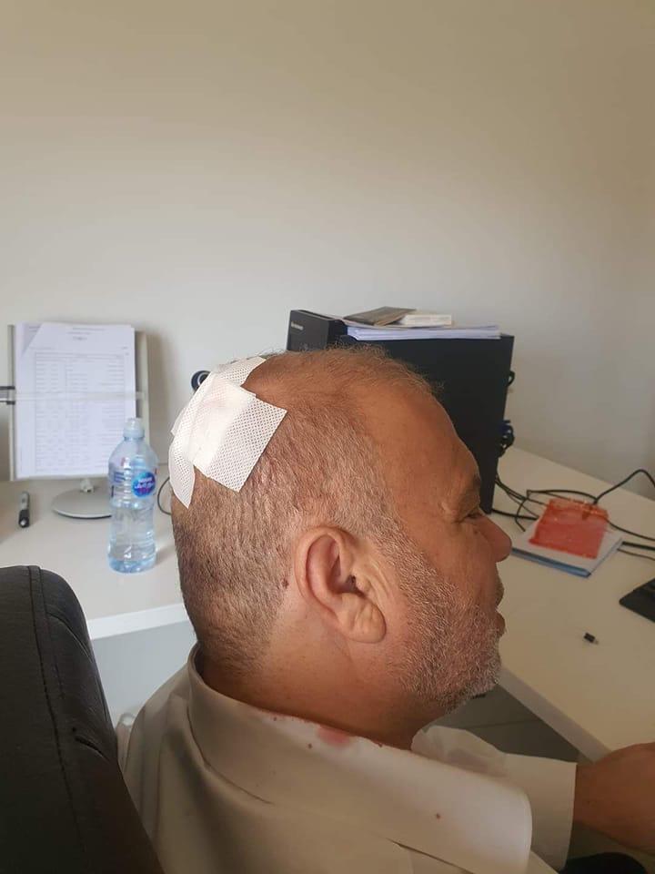 إصابة رئيس مجلس محافظة الزرقاء بحبة برد