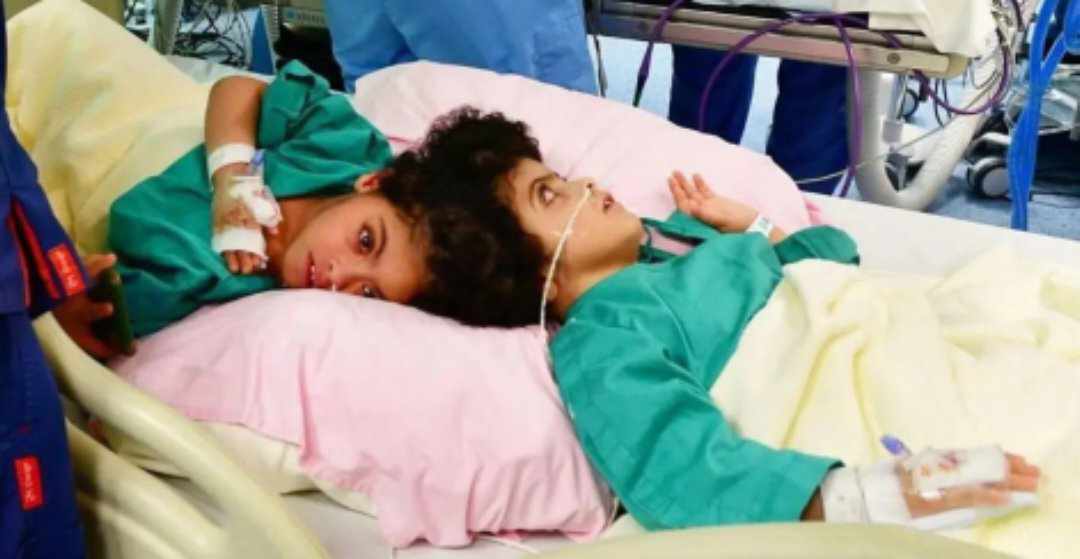 نجاح فصل توأم سيامي سوري بعد عملية جراحية دقيقة