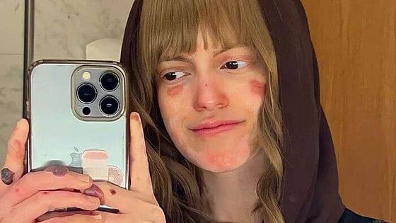 سعودية تتحدى إصابتها بمرض نادر وتواجه التنمر