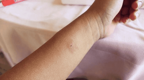 طبيب أردني: خطورة من لسعة الحشرات بالصيف قال اختصاصي الامراض الصدرية والتنفسية
