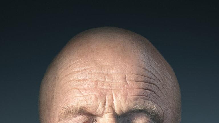 أليكم الدول الأعلى كثافة بالصلعان.. وما هو السبب؟