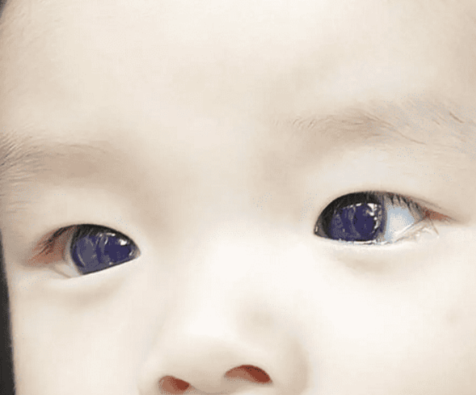 بسبب عقار مضاد لكورونا.. عينا طفل تحولتا من البني للأزرق