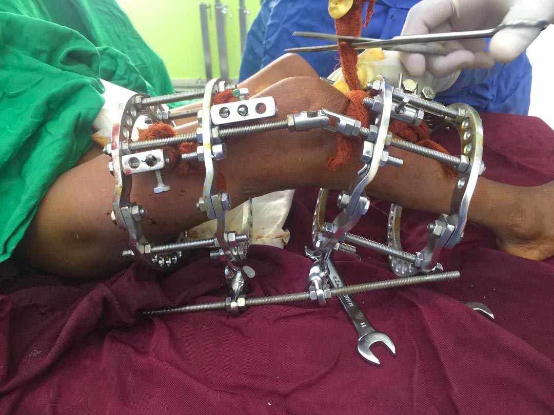 طبيب يمني يستخدم تقنية جديدة لإعادة الحياة لطفلة تعاني من تشوه خلقي...صور