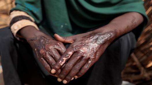 تقرير: القتل على أساس عرقي يودي بحياة نحو 15 ألفا في مدينة سودانية واحدة