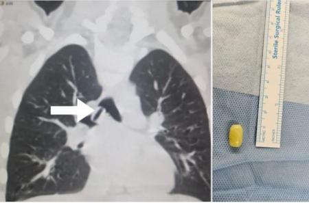 استخراج خرزة مسبحة من الشُّعَب الهوائية لطفل في السعودية