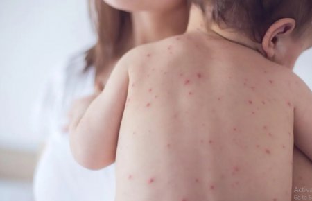 المفرق والزرقاء الأكثر تسجيلا بمرض الجدري