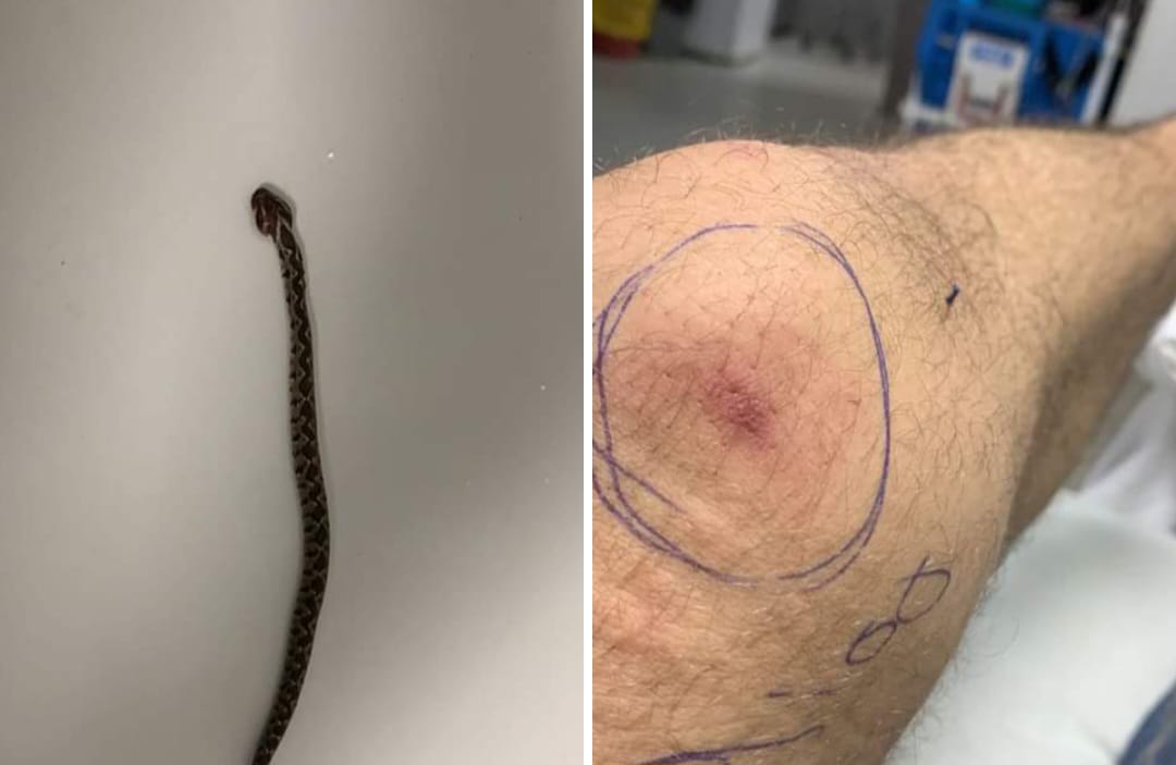 شاب أردني يتعرض للدغة افعى فلسطين السامة خلال قيامه بعملية قطف ثمار الزيتون وخبرا يحذرون