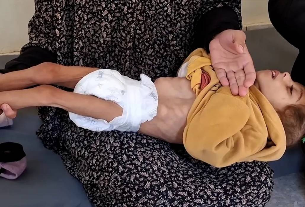 وفاة طفل آخر في غزة نتيجة الجوع وسوء التغذية