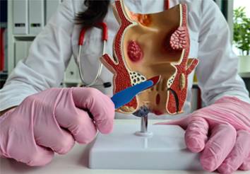 البواسير.. الأنواع الأسباب وطرق العلاج الفعالة