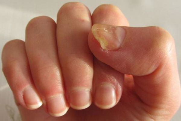 الكالسيوم.. المعدن الحيوي لصحة العظام والبشرةعلامات نقصه تبدأ من الأظافر