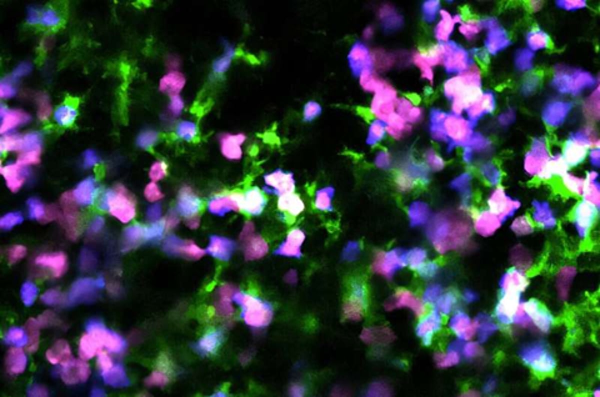 دراسة: خلايا سرطان الدم الميتة تنشّط الجهاز المناعي للقضاء على المرض