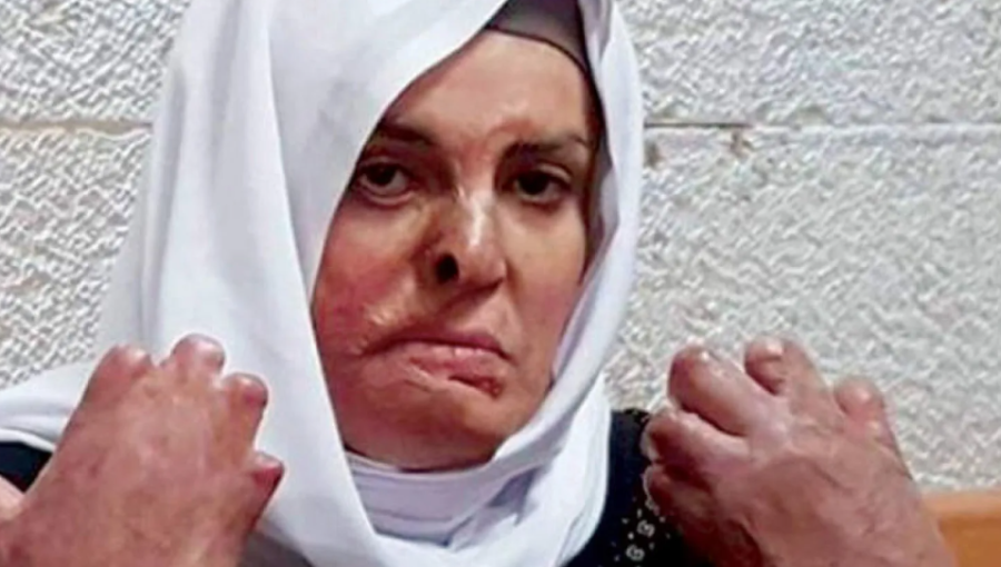 الأسيرة المحررة جعابيص تجري عمليتها الجراحية الـ 20 في الأردن