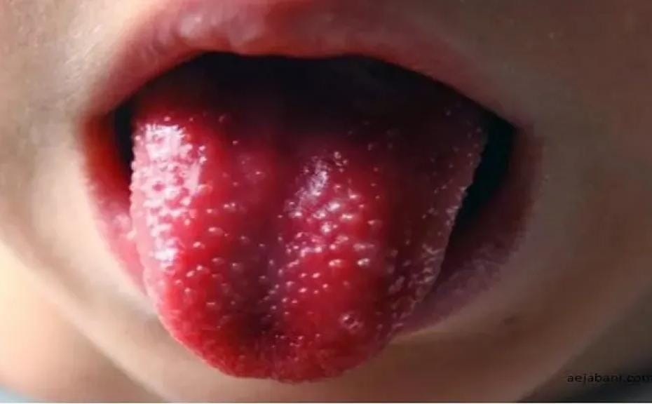 ما هو مرض كاواساكي عند الأطفال؟.. أعراض خطيرة تستدعي التدخل السريع