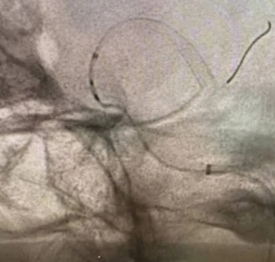 عملية نوعية لإنقاذ حياة مريض يعاني من نزيف دماغي حاد في مستشفى الملك المؤسس