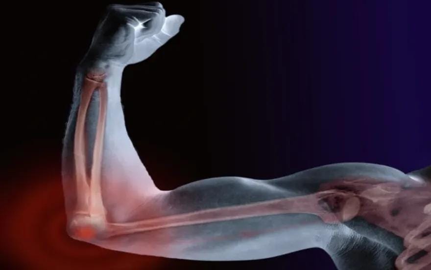 6 أطعمة طبيعية تقوي العظام وتمنع هشاشتها مع التقدم في العمر