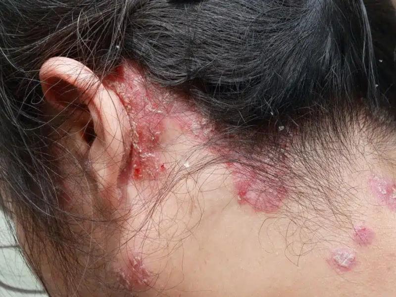 الصدفية والإكزيما.. تعرف على الفروق وأهم طرق السيطرة على الأعراض