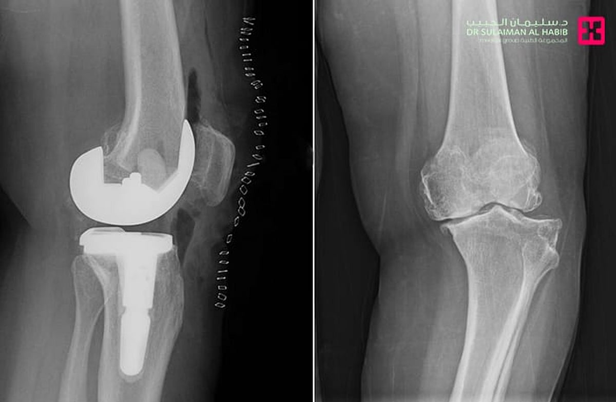 مستشفى الدكتور سليمان الحبيب بالقصيم ينهي معاناة ستينية بعملية استبدال مفصل ركبة نوعية