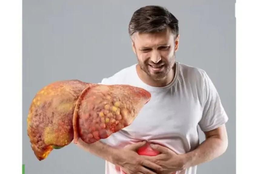 الكشف عن 10 أطعمة تخلصك من الكبد الدهني نهائيًا