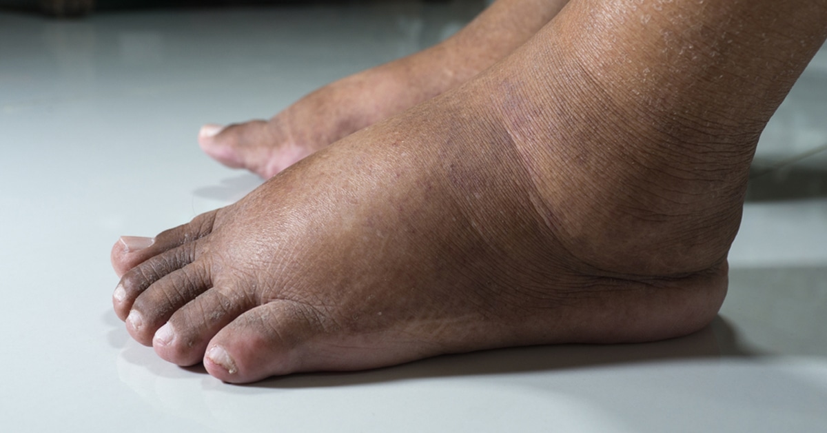 تورم الكاحلين.. 10 أسباب شائعة وحلول فعّالة