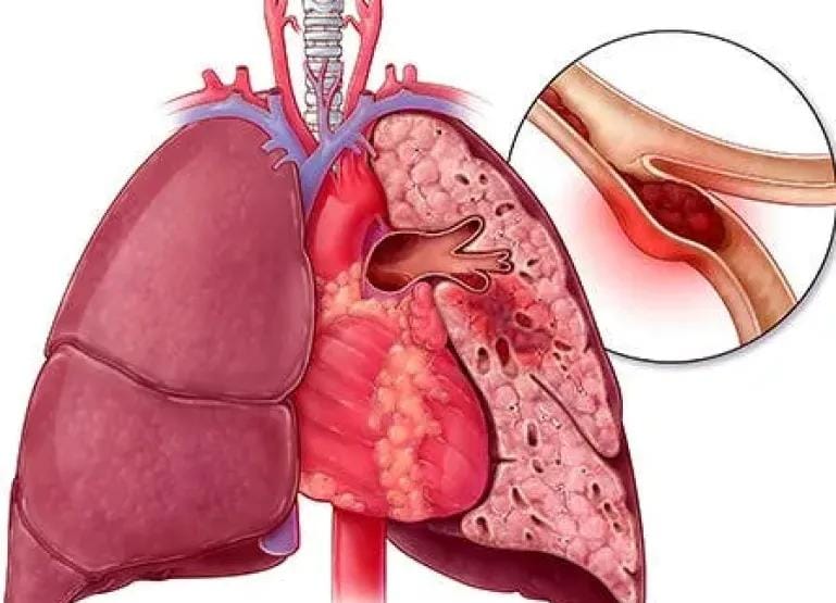 اكتشف العلامات الخفية للانسداد الرئوي وفحوصات ضرورية للتشخيص المبكر