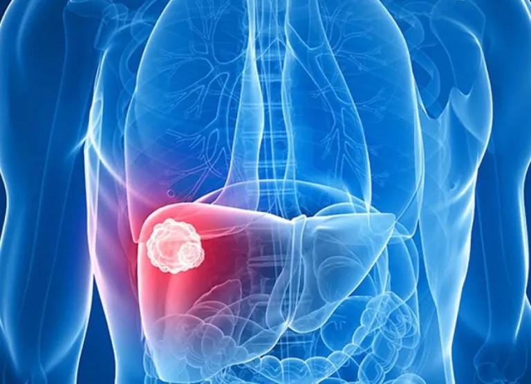 الكبد الدهني.. العلامات المبكرة التي يمكنك ملاحظتها في المنزل